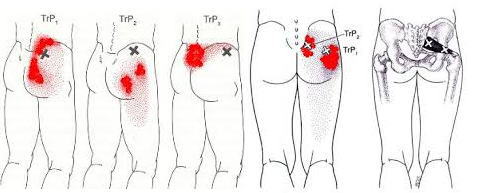 腰痛　トリガーポイント